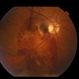 Subretinal Hemorrhage Subretinal Hemorrhage